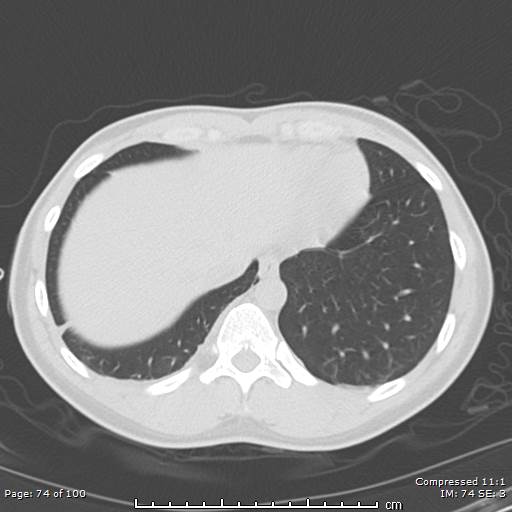 File:Catamenial pneumothorax (Radiopaedia 54382-60600 Axial non-contrast 74).jpg