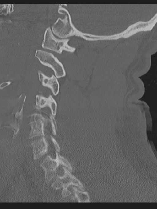 Cavernoma of cervical cord (Radiopaedia 50838-56346 Sagittal bone window 52).png