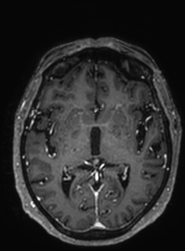 File:Cavernous hemangioma of the cerebellar falx (Radiopaedia 73025-83724 Axial T1 C+ 175).jpg