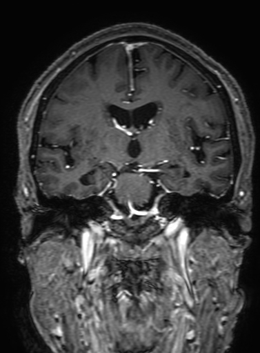 Cavernous hemangioma of the cerebellar falx (Radiopaedia 73025-83724 Coronal T1 C+ 188).jpg
