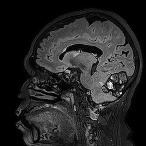 File:Cavernous hemangioma of the cerebellar falx (Radiopaedia 73025-83724 Sagittal FLAIR 128).jpg