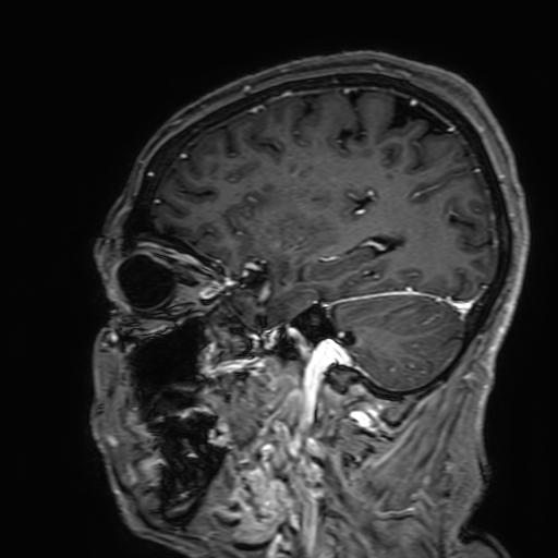 Cavernous hemangioma of the cerebellar falx (Radiopaedia 73025-83724 Sagittal T1 C+ 61).jpg