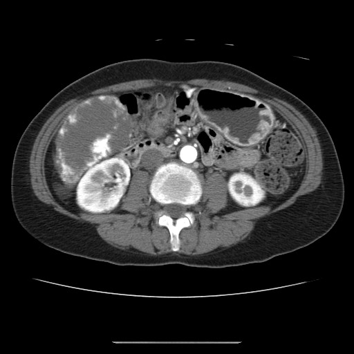 File:Cavernous hepatic hemangioma (Radiopaedia 75441-86667 A 58).jpg