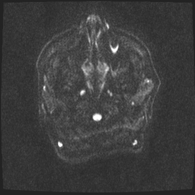 File:Cavernous sinus meningioma (Radiopaedia 63682-72367 DWI 41).jpg