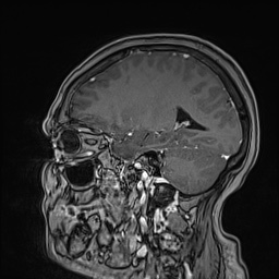 Cavernous sinus meningioma (Radiopaedia 63682-72367 Sagittal T1 C+ 114).jpg