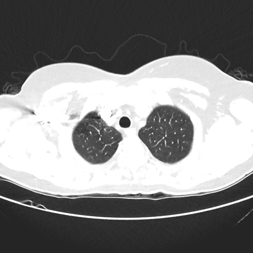 File:Cavitating lung mass - squamous cell carcinoma (Radiopaedia 48047-52854 Axial lung window 9).png
