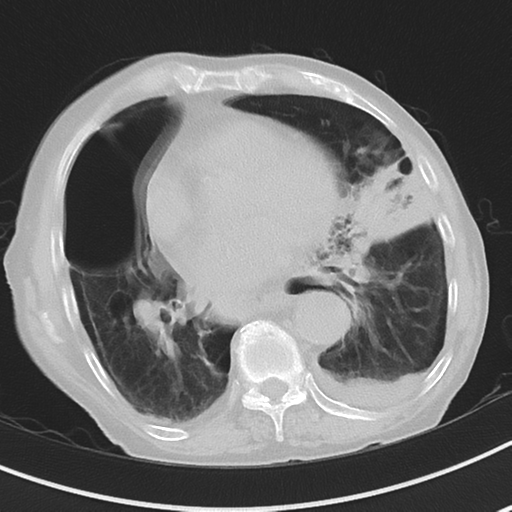Cavitating pneumonia - lingular segments (Radiopaedia 34386-35678 Axial lung window 38).png
