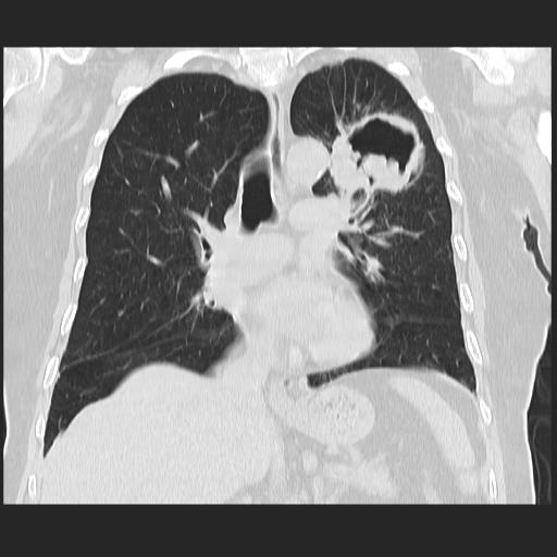 File:Cavitating pulmonary metastases (Radiopaedia 89545-106544 Coronal lung window 22).jpg