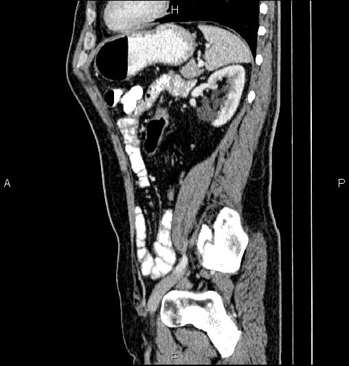Cecal adenocarcinoma (Radiopaedia 85324-100916 E 65).jpg