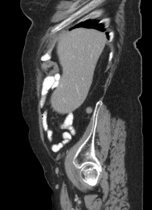 Cecal adenocarcinoma - surgical scar recurrence (Radiopaedia 79988-93264 D 53).jpg