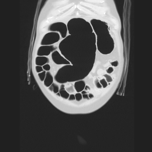 Cecal volvulus (Radiopaedia 75378-86620 Coronal lung window 31).jpg