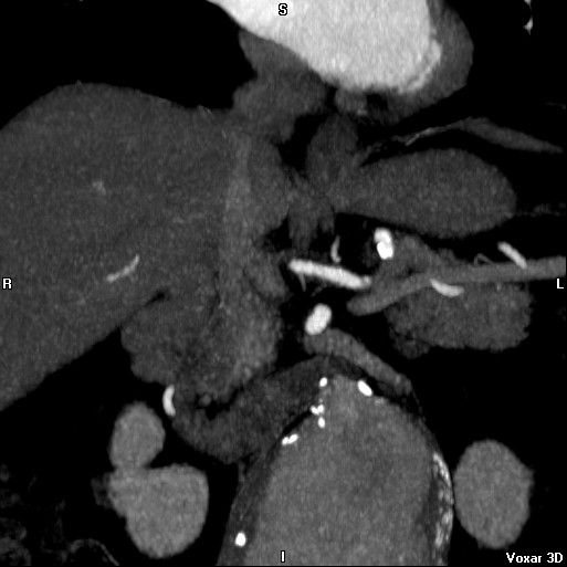 File:Celiac artery anatomy (Radiopaedia 16763-16476 A 10).jpg