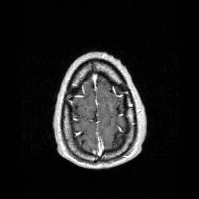 Central-variant posterior reversible encephalopathy syndrome (PRES) (Radiopaedia 43880-47358 Axial T1 C+ 156).jpg