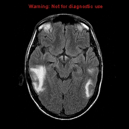 File:Central nervous system vasculitis (Radiopaedia 8410-9235 Axial FLAIR 10).jpg