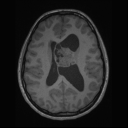 File:Central neurocytoma (Radiopaedia 37664-39557 Axial T1 44).png