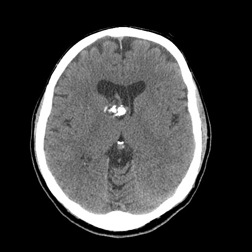 Central neurocytoma (Radiopaedia 68725-78432 Axial non-contrast 25).jpg