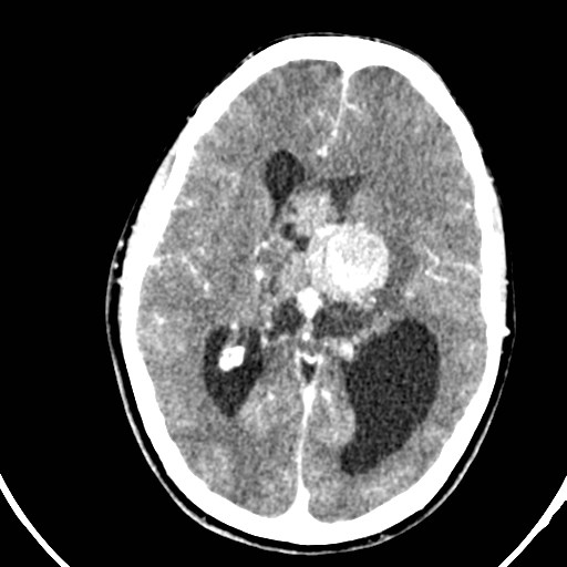 Central neurocytoma (Radiopaedia 84497-99871 B 24).jpg