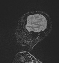 Central neurocytoma (Radiopaedia 84497-99872 Sagittal Flair + Gd 132).jpg