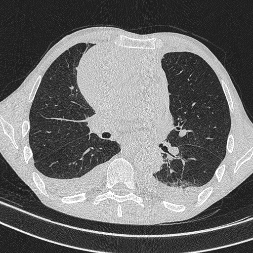 Central venous catheter tip extravasation (Radiopaedia 82828-97113 Axial lung window 44).jpg