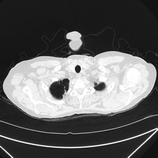 Centrilobular pulmonary emphysema (Radiopaedia 24495-24789 Axial lung window 4).jpg