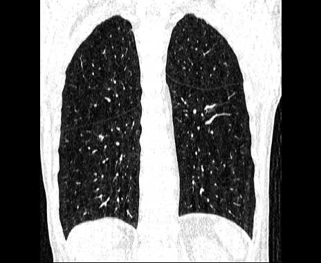 Centrilobular pulmonary emphysema (Radiopaedia 62468-70718 Coronal lung window 54).jpg