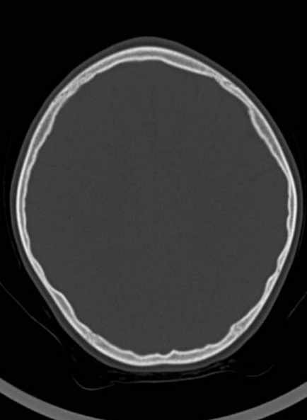 Cerebellar abscess (Radiopaedia 73727-84527 Axial bone window 48).jpg