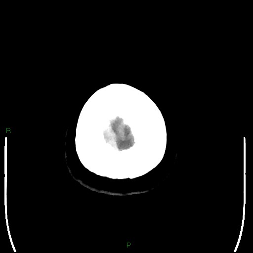Cerebellar abscess (Radiopaedia 78135-90671 Axial non-contrast 109).jpg