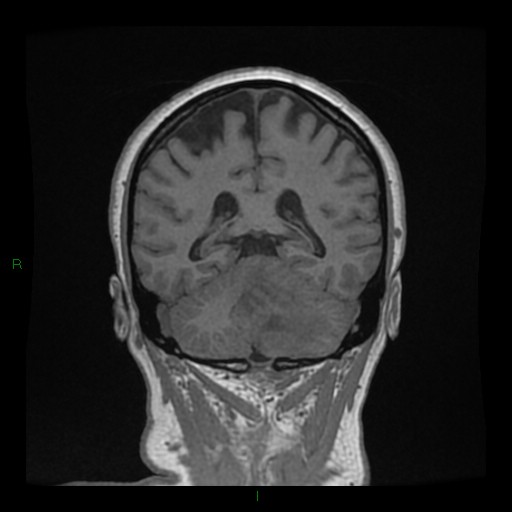 Cerebellar abscess (Radiopaedia 78135-90678 Coronal T1 C+ 109).jpg