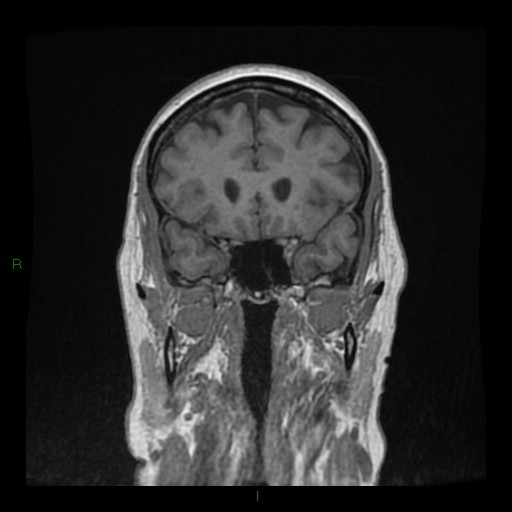 Cerebellar abscess (Radiopaedia 78135-90678 Coronal T1 C+ 52).jpg