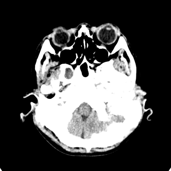 File:Cerebellar abscess secondary to mastoiditis (Radiopaedia 26284-26412 Axial non-contrast 21).jpg
