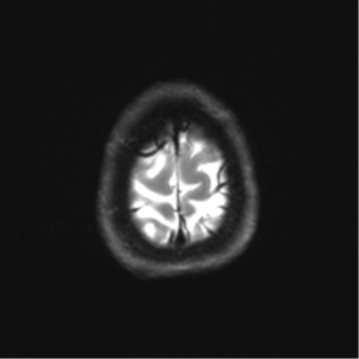 Cerebellar agenesis with hypoplastic pons (pontocerebellar hypoplasia) (Radiopaedia 57224-64138 Axial DWI 35).png
