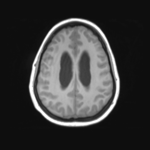 File:Cerebellar ependymoma complicated by post-operative subdural hematoma (Radiopaedia 83322-97736 Axial T1 29).png