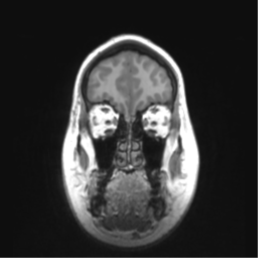 Cerebellar ependymoma complicated by post-operative subdural hematoma (Radiopaedia 83322-97736 Coronal T1 10).png