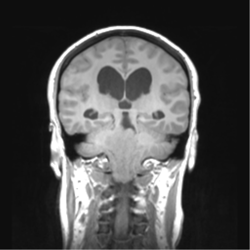 Cerebellar ependymoma complicated by post-operative subdural hematoma (Radiopaedia 83322-97736 Coronal T1 34).png