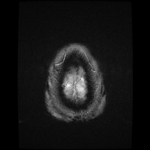 File:Cerebellar hemangioblastoma (Radiopaedia 88055-104622 Axial Gradient Echo 20).jpg