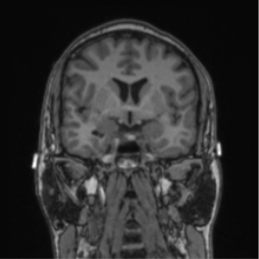Cerebellar hemangioblastomas and pituitary adenoma (Radiopaedia 85490-101176 Coronal T1 54).png