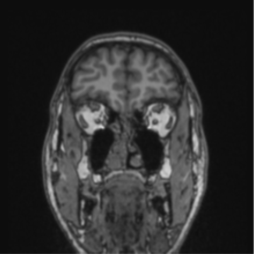Cerebellar hemangioblastomas and pituitary adenoma (Radiopaedia 85490-101176 Coronal T1 73).png