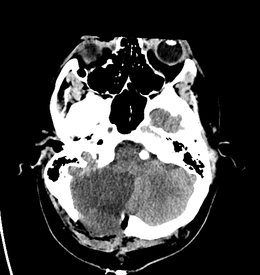 File:Cerebellar infarct due to vertebral artery dissection with posterior fossa decompression (Radiopaedia 82779-97031 Axial non-contrast 7).png