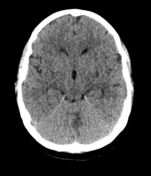 Cerebellar metastases - colorectal adenocarcinoma (Radiopaedia 40947-43652 Axial non-contrast 25).png