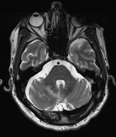 File:Cerebellar metastasis (Radiopaedia 33616-34718 Axial T2 11).png
