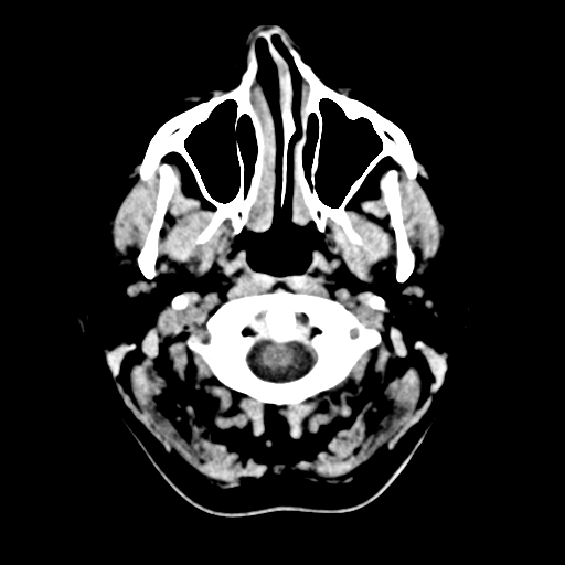 Cerebellar metastasis (Radiopaedia 54578-60812 Axial non-contrast 1).png