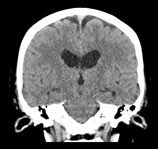Cerebellar metastasis (Radiopaedia 54578-60812 Coronal non-contrast 30).png