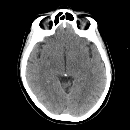 Cerebellar metastasis (cystic appearance) (Radiopaedia 41395-44258 Axial non-contrast 25).png