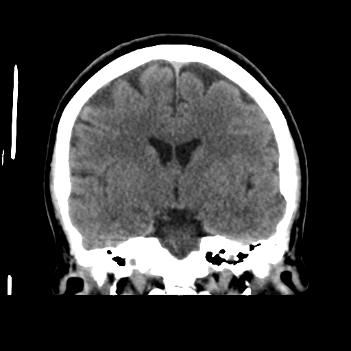 Cerebellar metastasis (cystic appearance) (Radiopaedia 41395-44258 Coronal non-contrast 32).png