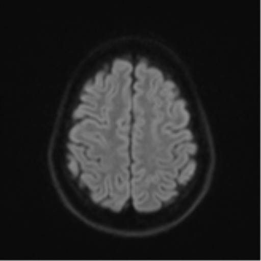 Cerebellar metastasis - adenocarcinoma lung (Radiopaedia 63184-71715 Axial DWI 52).png