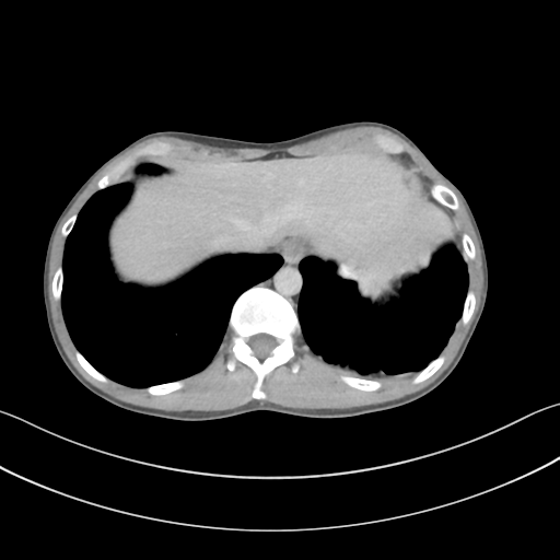 Cerebellar metastasis - adenocarcinoma lung (Radiopaedia 63184-71717 Axial C+ delayed 59).png