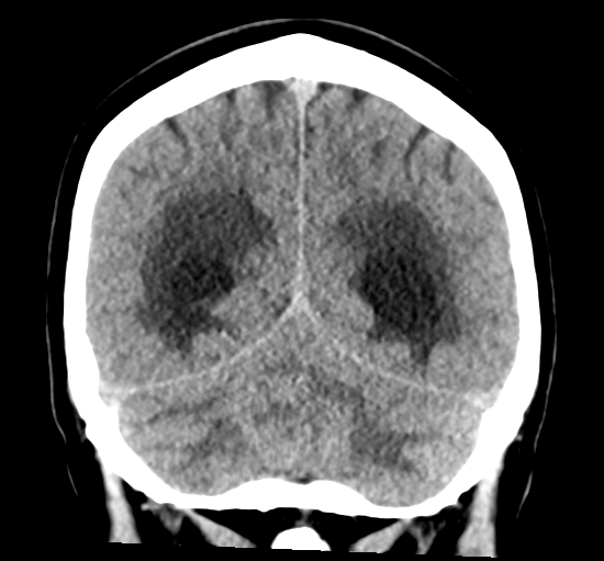 File:Cerebellar metastasis from lung adenocarcinoma (Radiopaedia 86690-102828 Coronal non-contrast 30).png