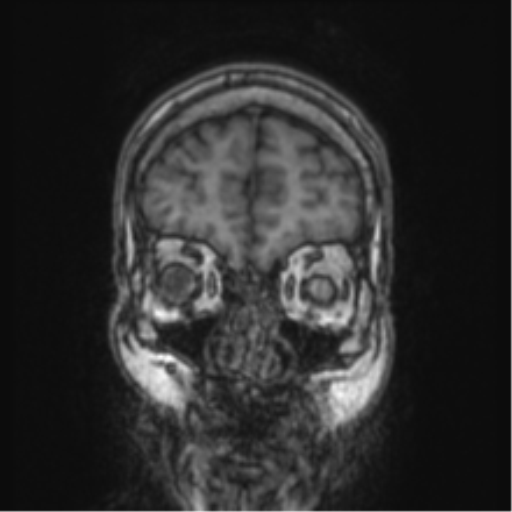 Cerebellar metastasis from lung adenocarcinoma (Radiopaedia 86690-102829 Coronal T1 85).png