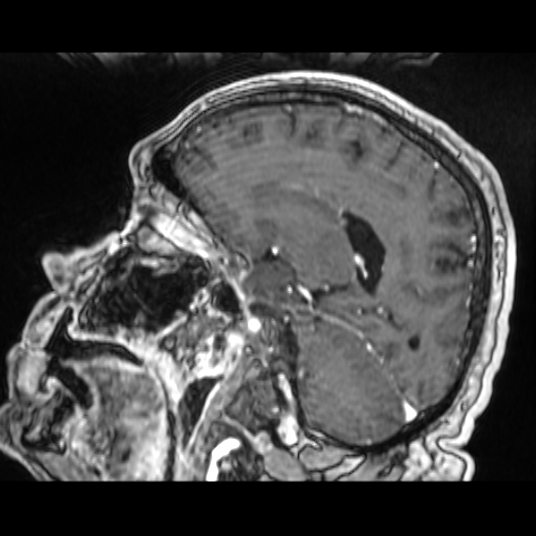 Cerebellar metastasis of pulmonary adenocarcinoma, cavernous venous malformation, and developmental venous anomaly (Radiopaedia 85827-101661 Sagittal T1 C+ 59).jpg
