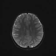 File:Cerebellar stroke (Radiopaedia 32202-33150 Axial DWI 16).png